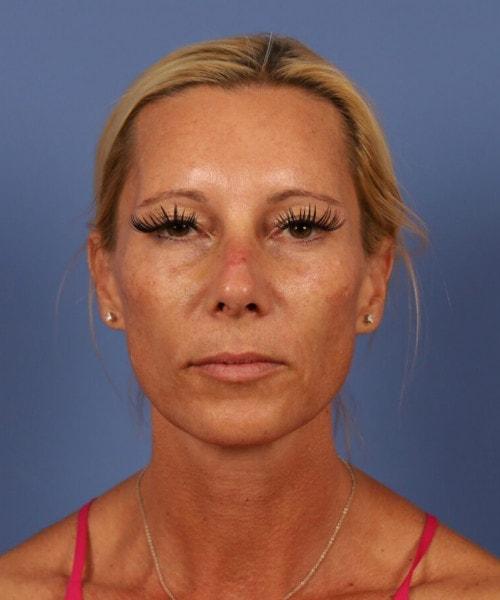 Ethnic Rhinoplasty before at Bitner Facial Plastic Surgery of Utah in Layton, UT