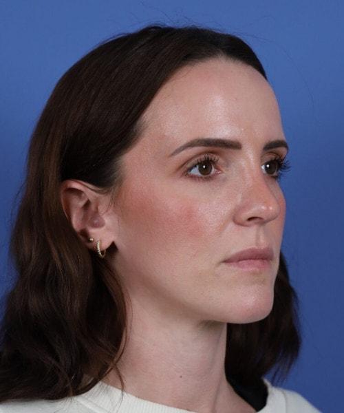 Ethnic Rhinoplasty after at Bitner Facial Plastic Surgery of Utah in Layton, UT