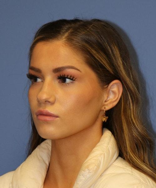 Ethnic Rhinoplasty before at Bitner Facial Plastic Surgery of Utah in Layton, UT