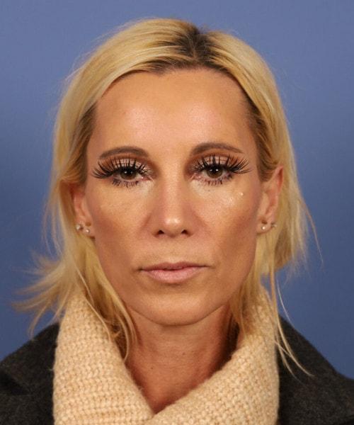 Ethnic Rhinoplasty after at Bitner Facial Plastic Surgery of Utah in Layton, UT