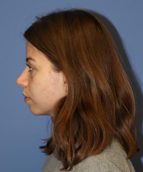 Rhinoplasty after at Bitner Facial Plastic Surgery of Utah in Salt Lake City, UT