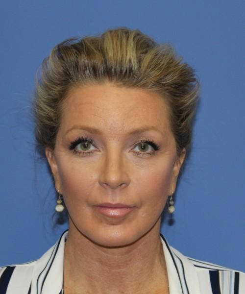 Facelift after at Bitner Facial Plastic Surgery of Utah in Layton, UT