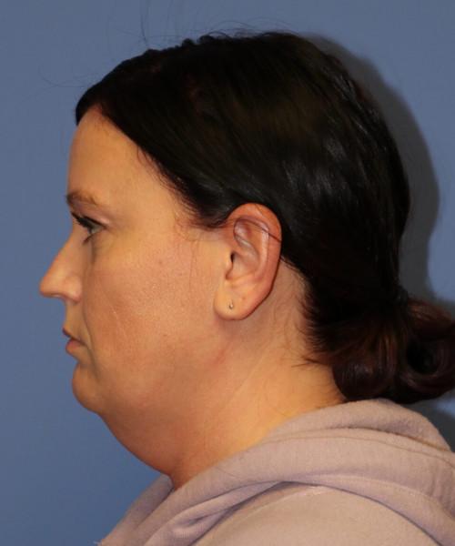 Neck Liposuction before at Bitner Facial Plastic Surgery of Utah in Salt Lake City, UT