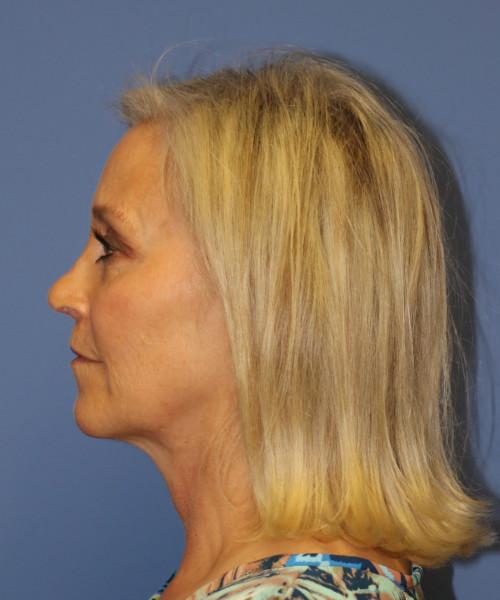 Bitner Facial Plastic Surgery of Utah rhinoplasty after — Salt Lake City, UT