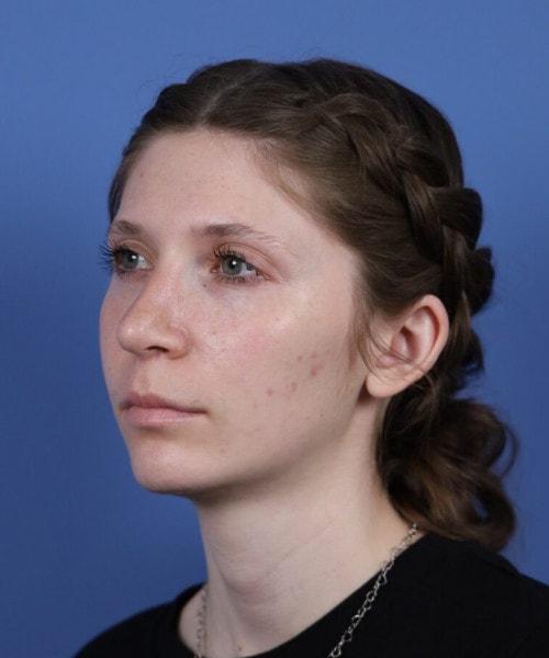 Ethnic Rhinoplasty after at Bitner Facial Plastic Surgery of Utah in Layton, UT