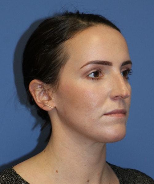Ethnic Rhinoplasty before at Bitner Facial Plastic Surgery of Utah in Layton, UT