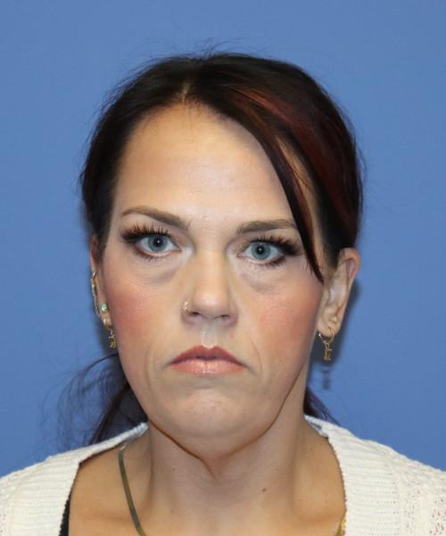 Facelift before at Bitner Facial Plastic Surgery of Utah in Layton, UT