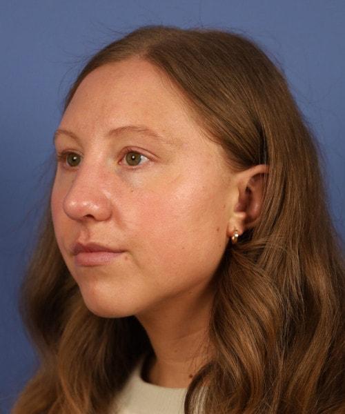 Ethnic Rhinoplasty after at Bitner Facial Plastic Surgery of Utah in Layton, UT