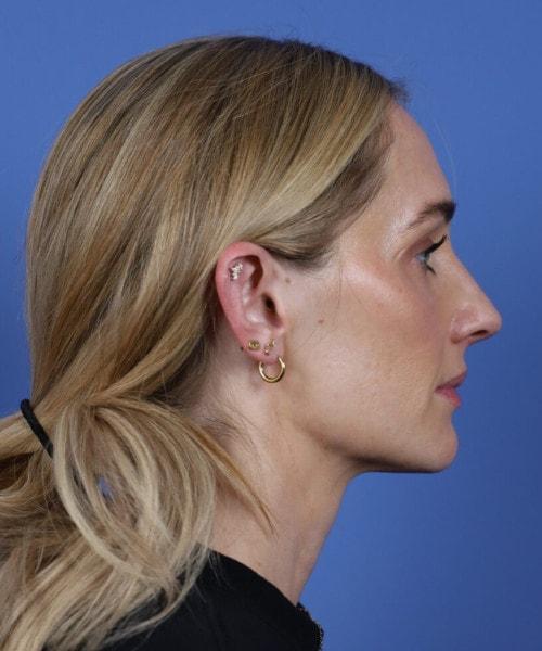Ethnic Rhinoplasty before at Bitner Facial Plastic Surgery of Utah in Layton, UT