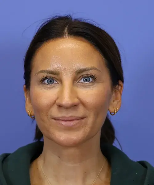 Chin Implant after at Bitner Facial Plastic Surgery of Utah in Salt Lake City, UT