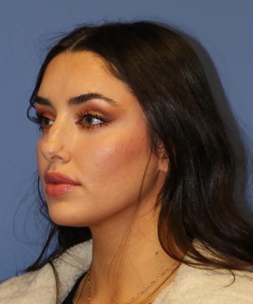 Rhinoplasty before