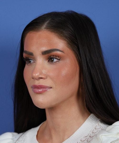 Ethnic Rhinoplasty after at Bitner Facial Plastic Surgery of Utah in Layton, UT