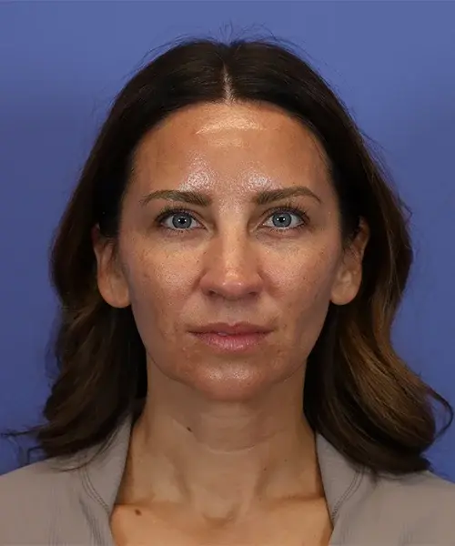 Chin Implant before at Bitner Facial Plastic Surgery of Utah in Salt Lake City, UT