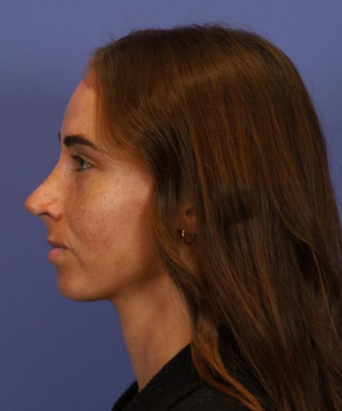Functional Rhinoplasty after at Bitner Facial Plastic Surgery of Utah in Layton, UT