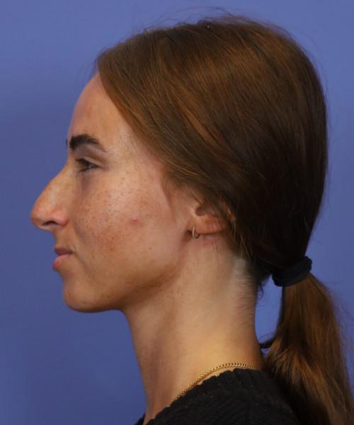 Functional Rhinoplasty before at Bitner Facial Plastic Surgery of Utah in Layton, UT
