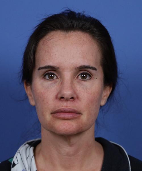 Facelift before at Bitner Facial Plastic Surgery of Utah in Layton, UT