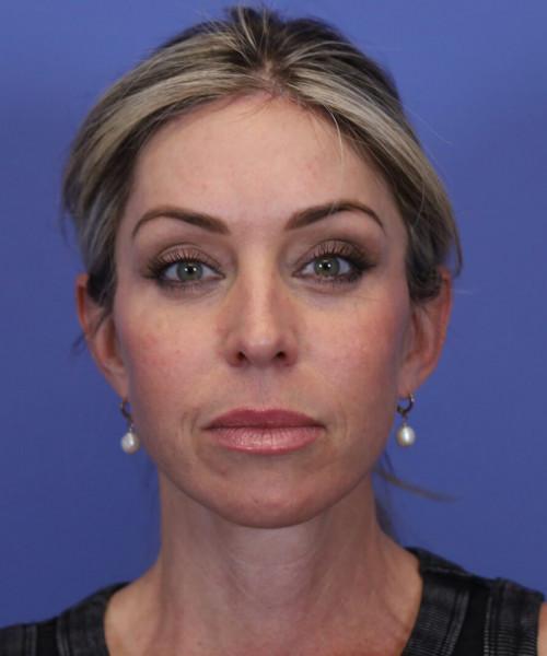 Facelift after at Bitner Facial Plastic Surgery of Utah in Layton, UT