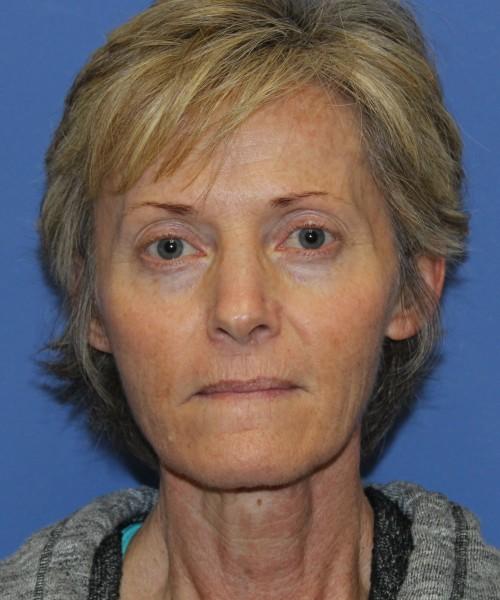 Brow Lift before at Bitner Facial Plastic Surgery of Utah in Salt Lake City, UT