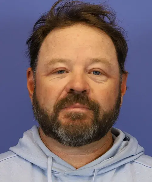 Blepharoplasty after at Bitner Facial Plastic Surgery of Utah in Layton, UT