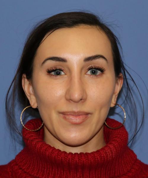Bitner Facial Plastic Surgery of Utah rhinoplasty after — Salt Lake City, UT