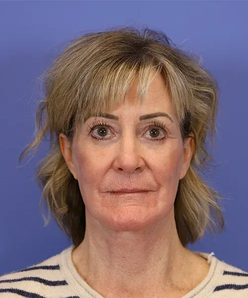 Blepharoplasty after at Bitner Facial Plastic Surgery of Utah in Salt Lake City, UT