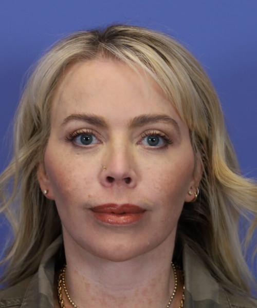 Facelift after at Bitner Facial Plastic Surgery of Utah in Layton, UT