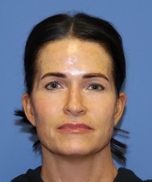 Rhinoplasty before at Bitner Facial Plastic Surgery of Utah in Layton, UT
