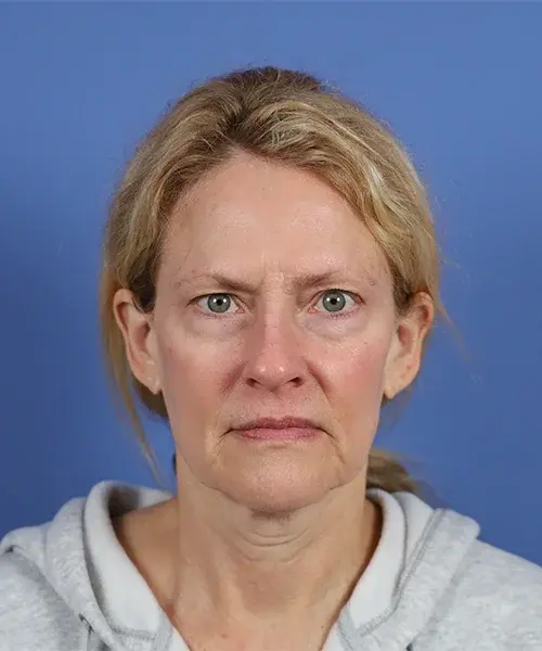 Brow Lift before at Bitner Facial Plastic Surgery of Utah in Salt Lake City, UT