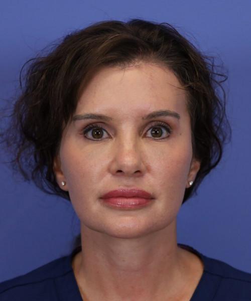 Facelift after at Bitner Facial Plastic Surgery of Utah in Layton, UT