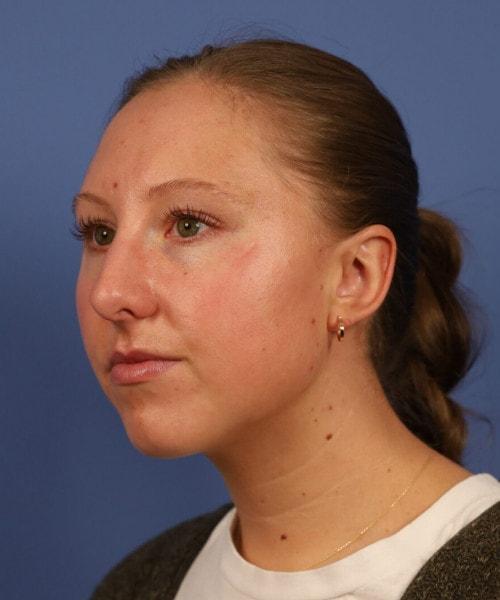 Ethnic Rhinoplasty before at Bitner Facial Plastic Surgery of Utah in Layton, UT