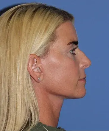 Neck Lift after at Bitner Facial Plastic Surgery of Utah in Salt Lake City, UT