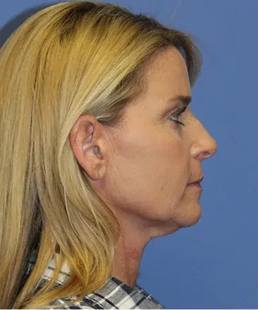 Neck Lift before at Bitner Facial Plastic Surgery of Utah in Salt Lake City, UT
