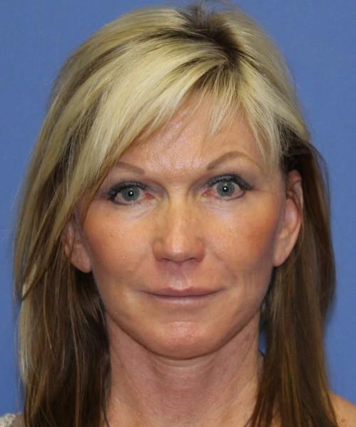 Brow Lift after at Bitner Facial Plastic Surgery of Utah in Salt Lake City, UT