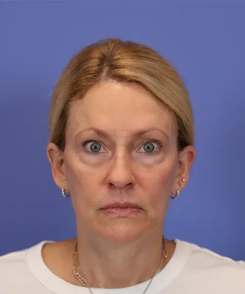 Brow Lift after at Bitner Facial Plastic Surgery of Utah in Salt Lake City, UT