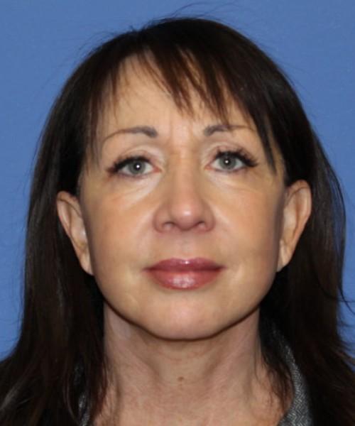 Bitner Facial Plastic Surgery of Utah facelift after — Salt Lake City, UT