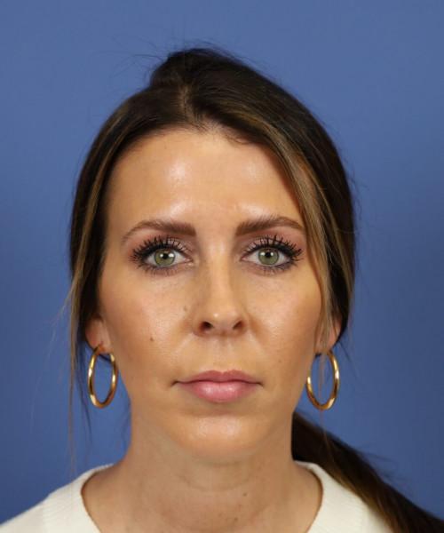 Chin Implant after at Bitner Facial Plastic Surgery of Utah in Salt Lake City, UT