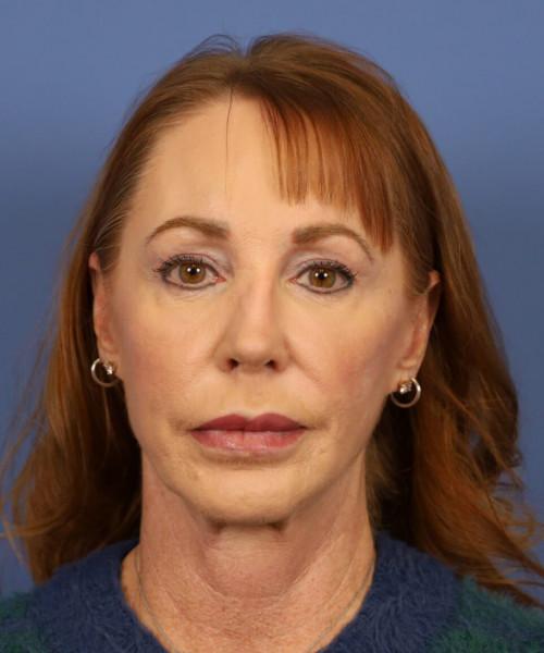 Rhinoplasty before at Bitner Facial Plastic Surgery of Utah in Layton, UT