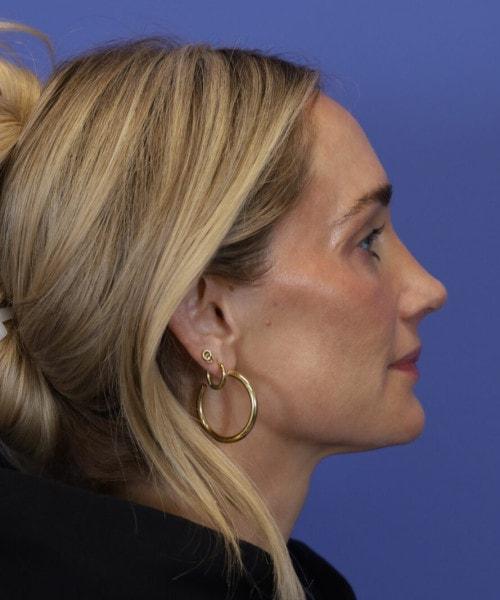 Ethnic Rhinoplasty after at Bitner Facial Plastic Surgery of Utah in Layton, UT