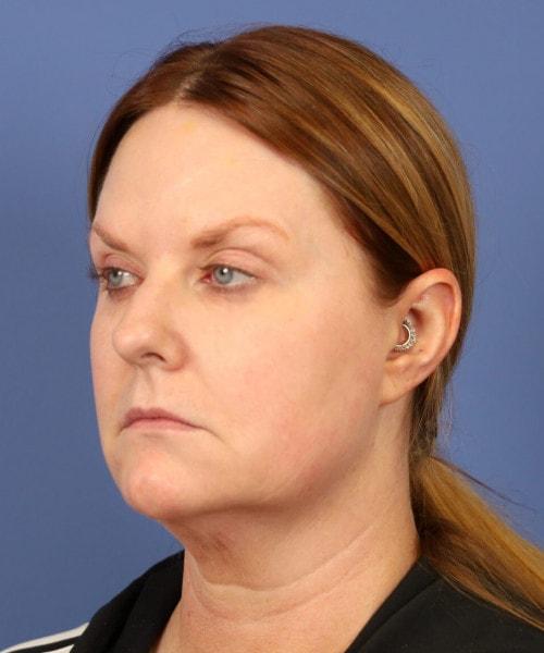 Neck Liposuction before at Bitner Facial Plastic Surgery of Utah in Layton, UT