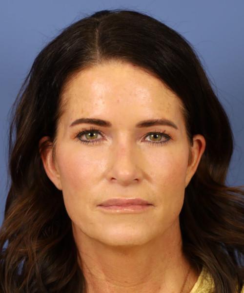 Rhinoplasty after at Bitner Facial Plastic Surgery of Utah in Layton, UT
