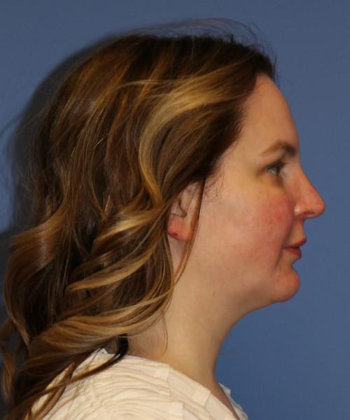 Neck Liposuction before at Bitner Facial Plastic Surgery of Utah in Salt Lake City, UT