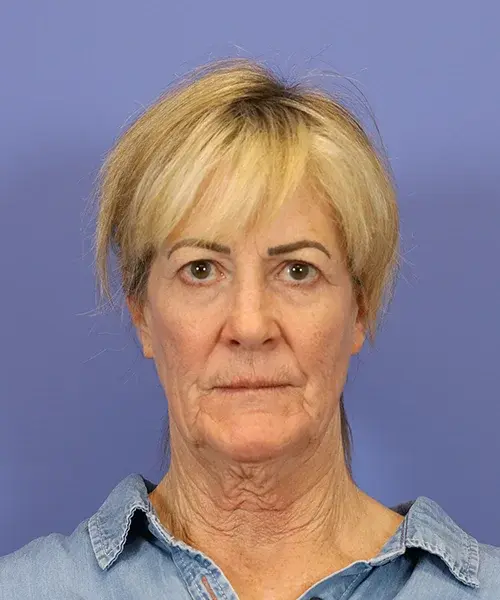 Blepharoplasty before at Bitner Facial Plastic Surgery of Utah in Salt Lake City, UT