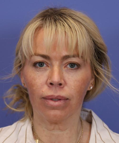 Facelift before at Bitner Facial Plastic Surgery of Utah in Layton, UT