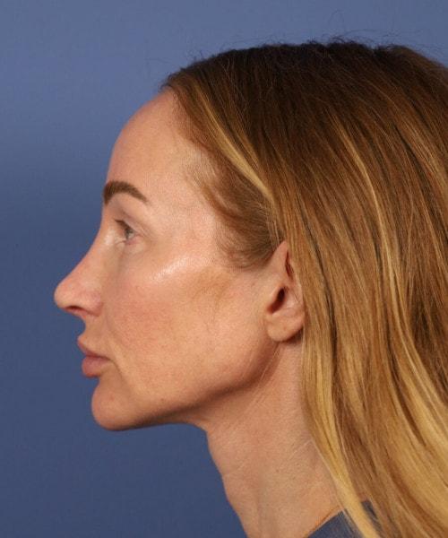 Ethnic Rhinoplasty after at Bitner Facial Plastic Surgery of Utah in Layton, UT