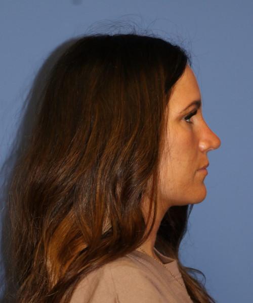 Bitner Facial Plastic Surgery of Utah rhinoplasty after — Salt Lake City, UT