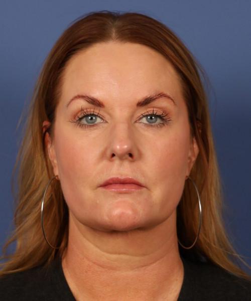 Bitner Facial Plastic Surgery of Utah skin tightening after — Salt Lake City, UT