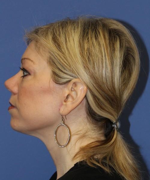 Facelift after at Bitner Facial Plastic Surgery of Utah in Layton, UT