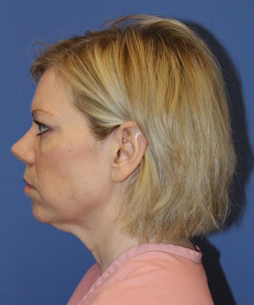 Facelift before at Bitner Facial Plastic Surgery of Utah in Layton, UT