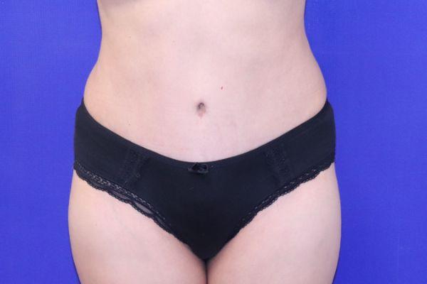 Tummy Tuck after at Farber Plastic Surgery in Delray Beach, FL