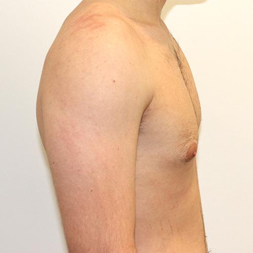 Farber Plastic Surgery gynecomastia after — Delray Beach, FL